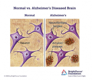normal vs alzheimer's disease brain